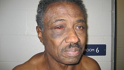 Herman Bell's facial injuries